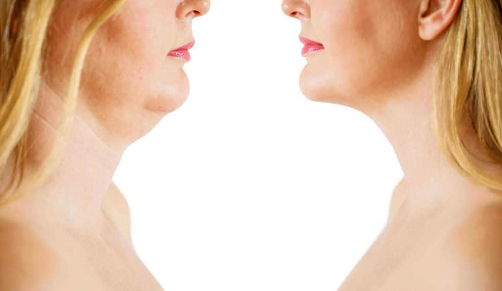 Double Chin treatment Warwick before and after results