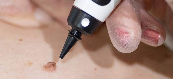 After Skin Tag Removal Warwick