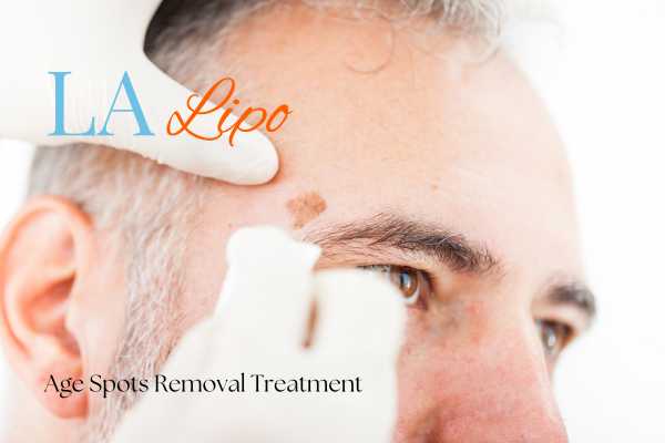 What Are the Most Effective Treatments for Age Spots Warwick?