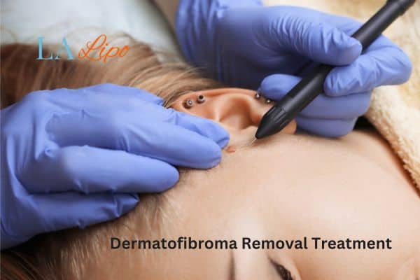 Dermatofibroma Removal Treatment Warwick