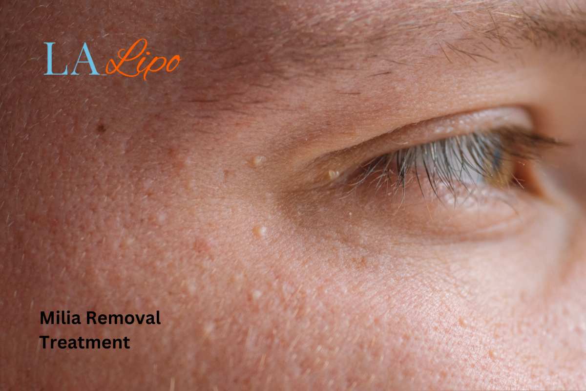 Cryopen Milia Removal: Is It the Easiest and Safest Option Warwick?