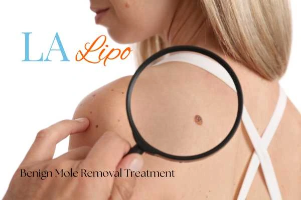 Why getting moles removed Warwick can boost your confidence!