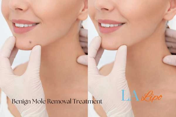 woman's before and after mole removal Warwick results