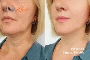 hi-fu for wrinkles Warwick before and after results