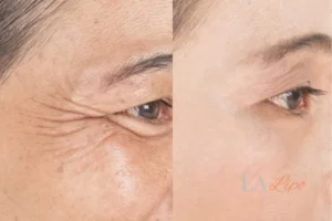 Before and after results of woman - HI-fu wrinkles reduction treatment Warwick