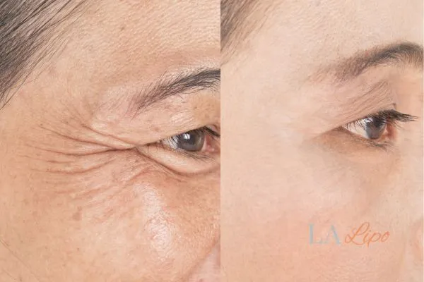 Before and after results of woman - HI-fu wrinkles reduction treatment Warwick
