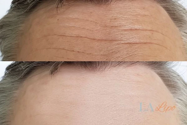 results of HIFU Warwick on mans forehead to help reduce lines and wrinkles