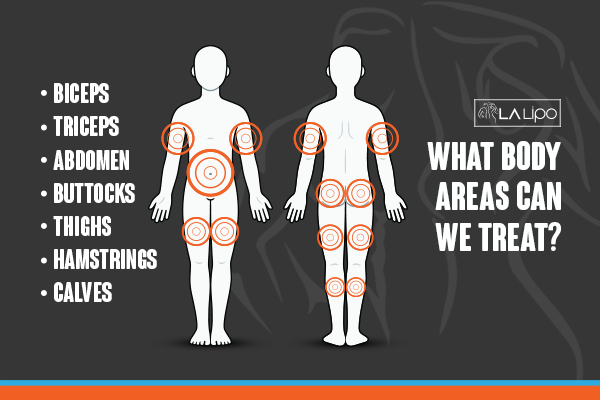 Graphic to show areas you can have LA-EMS Body Sculpting Warwick treatment.