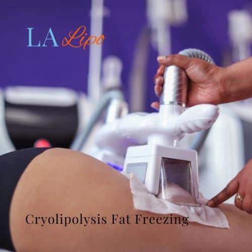 fat freezing - Cryolipolysis Warwick