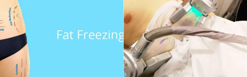 multi areas of a persons body having coolsculpting Warwick treatment