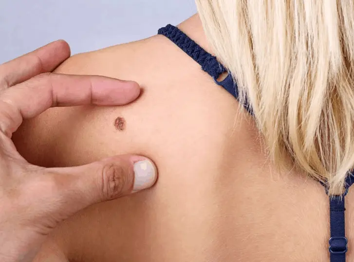 woman having mole removal Warwick consultation before treatment.