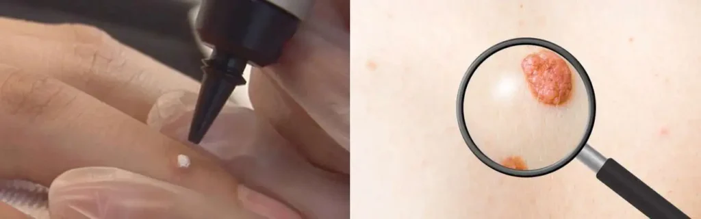 Cryopen for mole removal Warwick - speak to our team today!