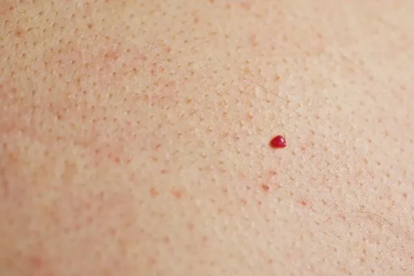 close up of a cherry angioma Warwick
