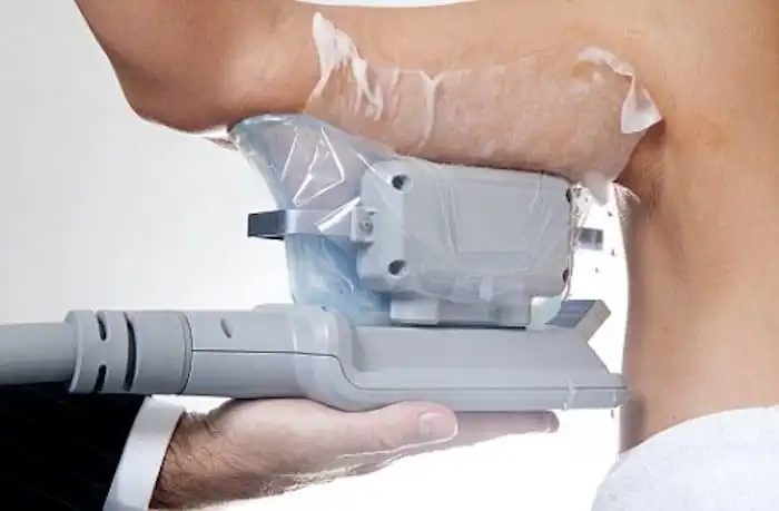Picture of fat freezing Warwick on the upper arms.