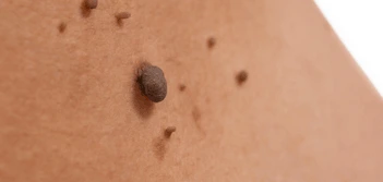 image of a skin tag Warwick