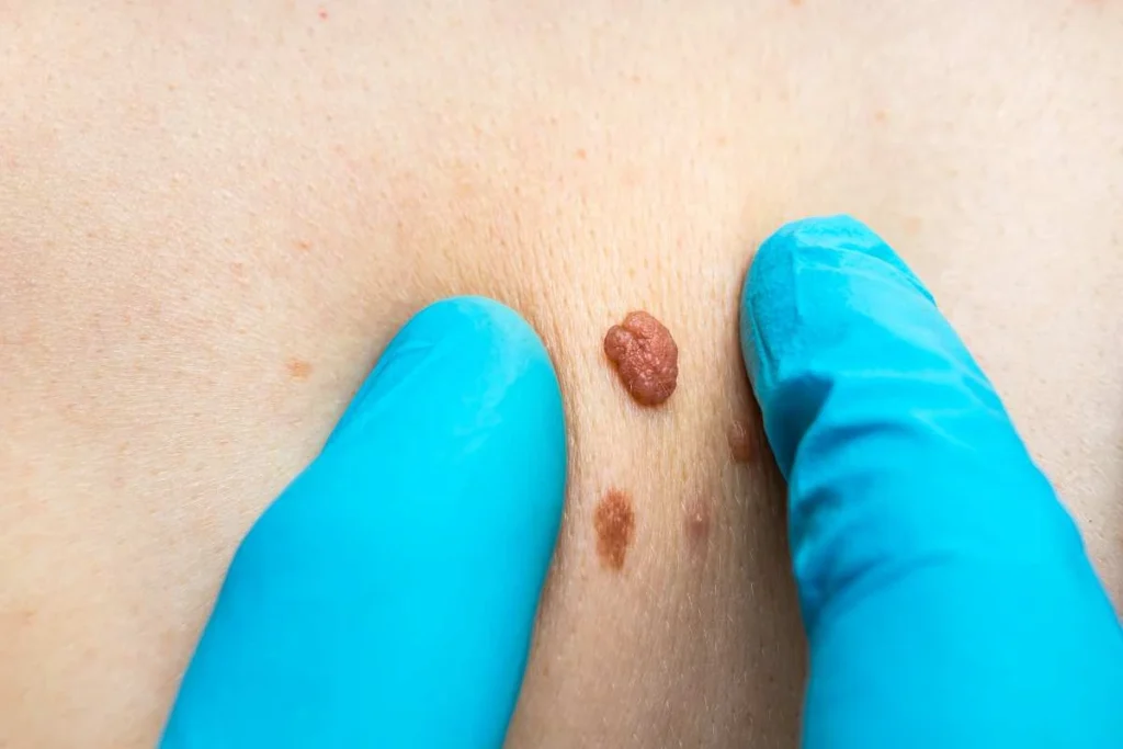 Consultant examining a skin tag Warwick