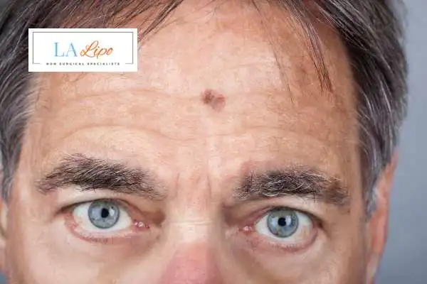 Solar Lentigo Removal Warwick image of man with mark on his forehead