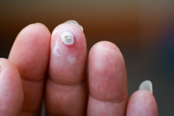 wart on person finger - cryotherapy to treat from LA LIPO Warwick