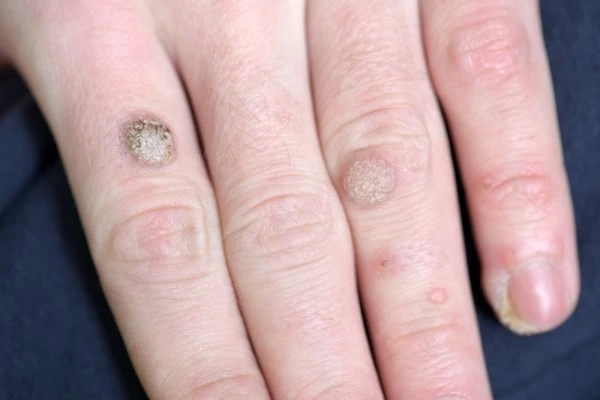 photo of warts on person hand - see wart removal Warwick from LA LIPO