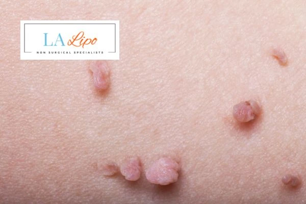 Does cryopen skin tag removal Warwick hurt? Find out now call our team today!