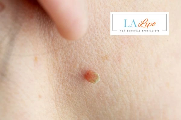 Book skin tag removal Warwick today speak to our team now!