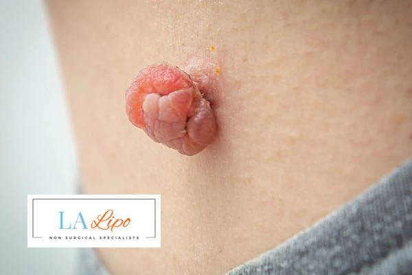 Interested in skin tag removal Warwick? Concerned about the pain? Find out more today!