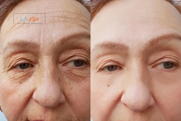 The powerful benefits of Morpheus8 Treatment Warwick - Call Our team today!