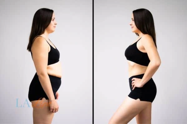 Picture of womans before and after using LA-EMS body sculpting to improve her core strength Warwick