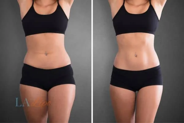 before and after results of non-surgical treatment to help a woman's body image and mental health Warwick