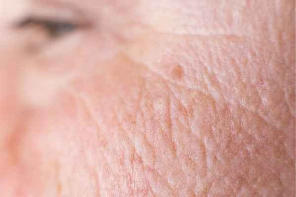 close up picture of a woman's face showing an age spot Warwick