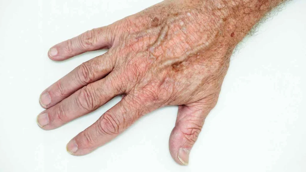 Male hand showing age spot Warwick