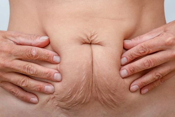 Image of a woman's stomach with loose skin - example of skin tightening Warwick options