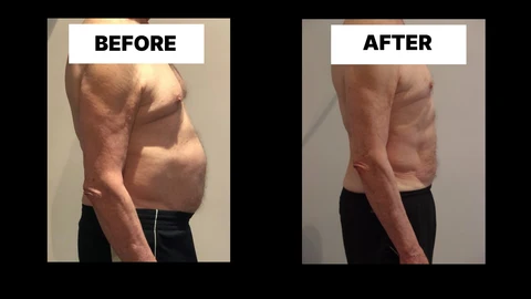 What Symptoms Can Diastasis Recti Cause in Men? Weak Core, Back Pain and Poor Posture Warwick
